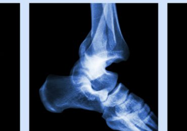 calcium-ne-previendrait-pas-fractures