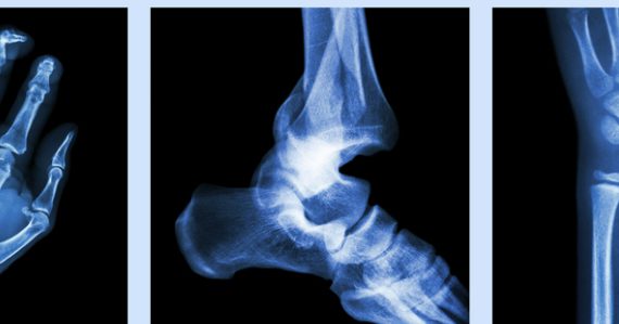 calcium-ne-previendrait-pas-fractures