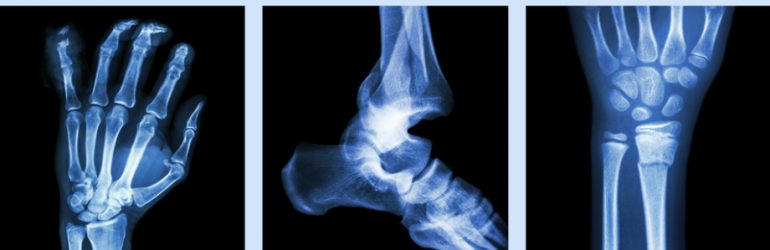 calcium-ne-previendrait-pas-fractures
