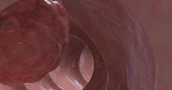 minder-gevallen-dikkedarmkanker-vegetariers