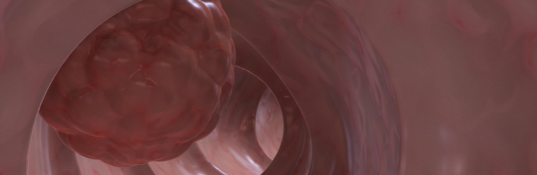 minder-gevallen-dikkedarmkanker-vegetariers