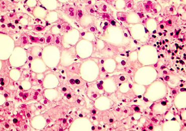 microbiote-nouvelle-cible-steatose-hepatique
