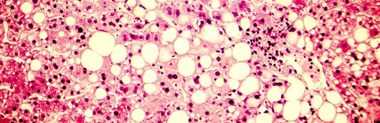 microbiote-nouvelle-cible-steatose-hepatique